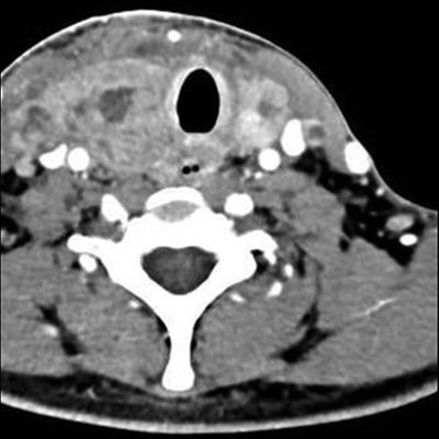 A Rare Case Of Nut Carcinoma Of The Thyroid 