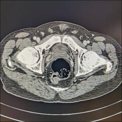 Emerging Role Of Gallium-68 Dotanoc Pet Ct Guided Radiofrequency 