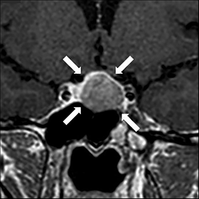 Ovarian Hyperstimulation Syndrome | Endocrine Society