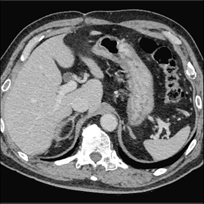 Reduction of Proteinuria in a Patient With PA by ARB Administration ...