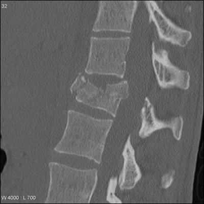 Unrecognized and Undertreated Vertebral Fractures | Endocrine Society