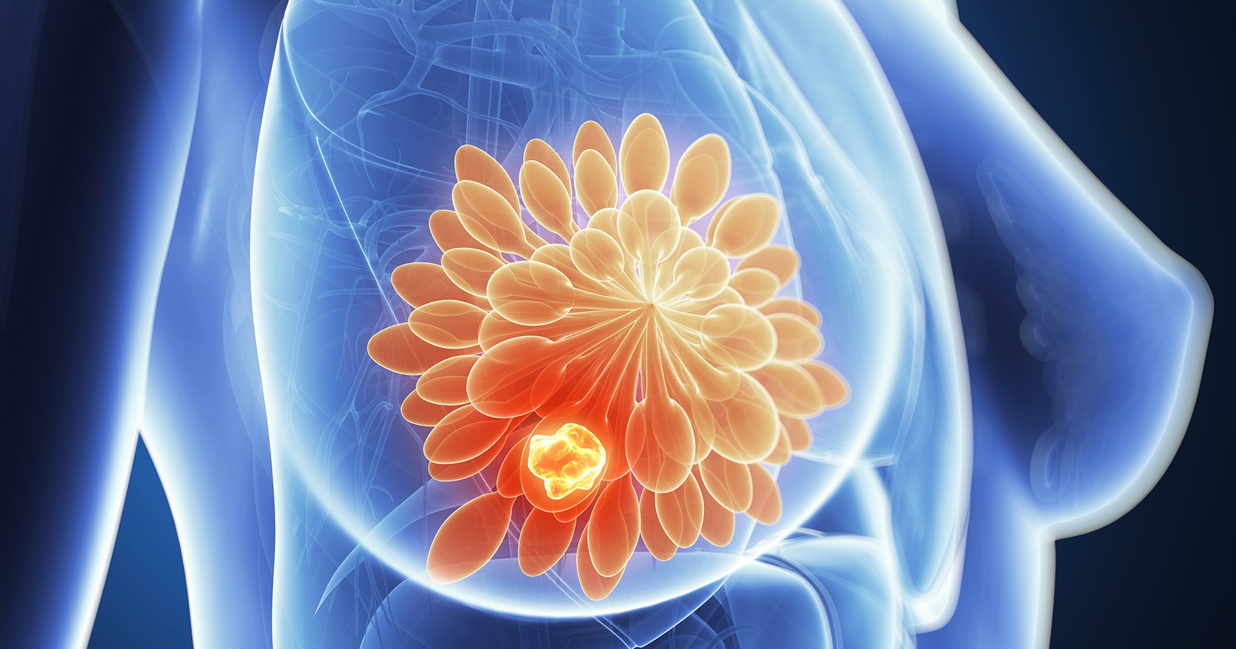 Post Breast Cancer: Hormones, Health, and Holistic Healing